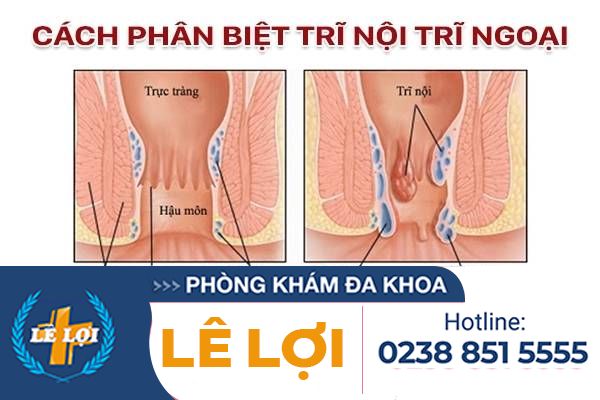 Phân biệt trĩ nội, trĩ ngoại như thế nào?