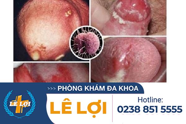 trieu-chung-benh-lau