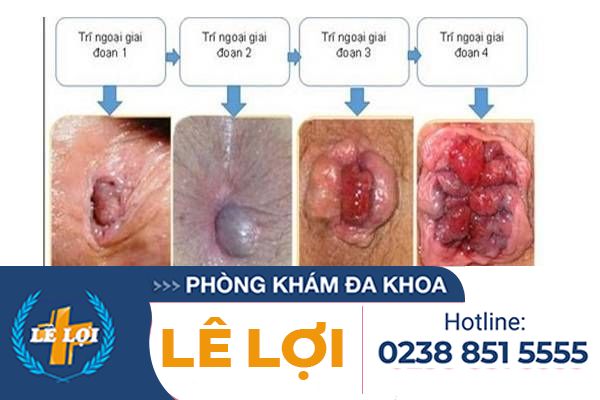 Trieu-chung-cua-benh-tri