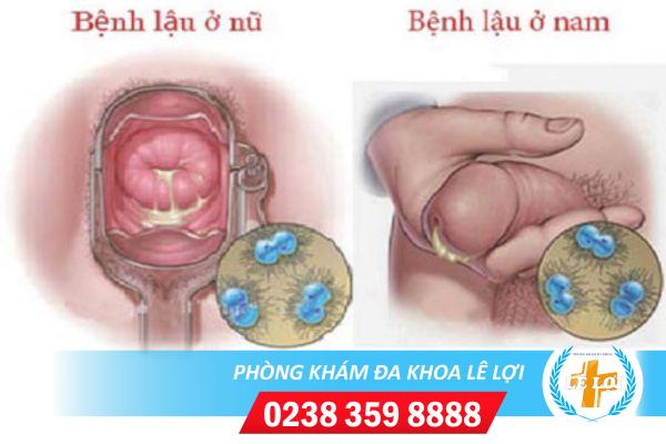 Bệnh lậu nguy hiểm như thế nào?