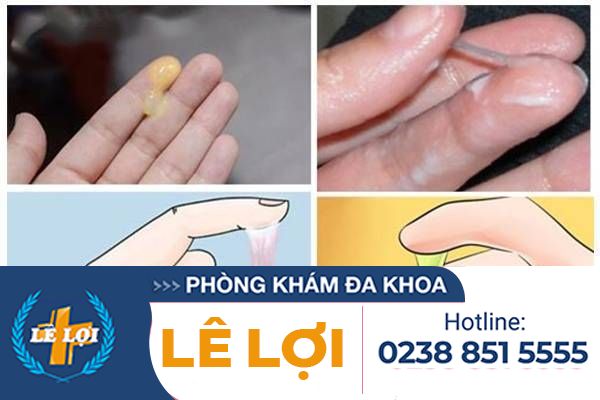 Cảnh giác với thay đổi màu sắc bất thường của huyết trắng phụ khoa