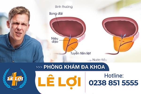Dấu hiệu nhận biết những bệnh tuyến tiền liệt ở nam giới