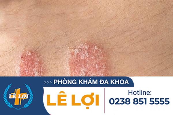 hien-tuong-vay-nen-o-duong-vat-1