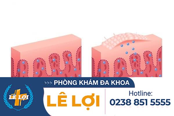 Hiện tượng vẩy nến ở dương vật