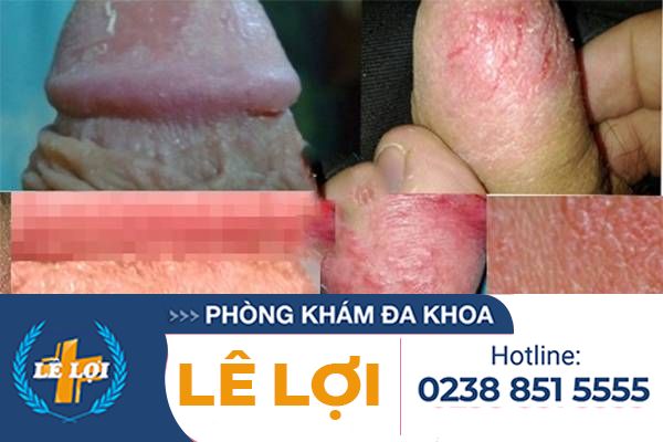 hinh-anh-bieu-hien-viem-bao-quy-dau-do-nam-candida-1