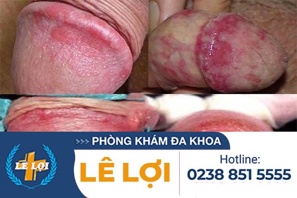 hinh-anh-bieu-hien-viem-bao-quy-dau-do-nam-candida-2