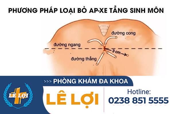 Phương pháp loại bỏ ap-xe tầng sinh môn – Liệu trình một lần duy nhất