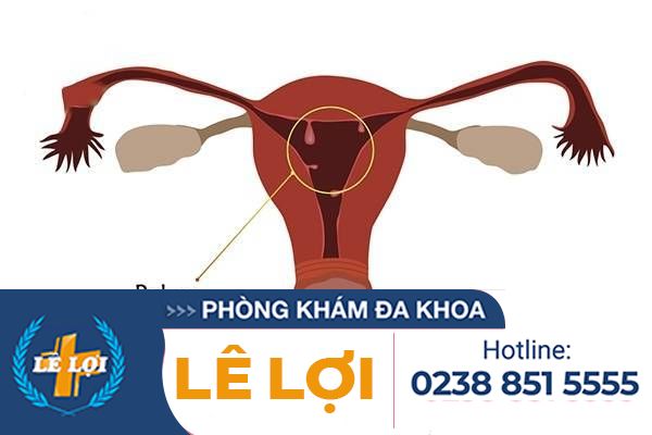 Polyp tử cung có thể nhận biết được không?