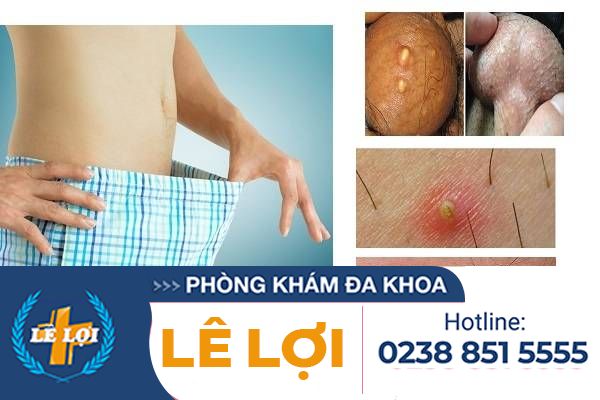 nguyen-nhan-noi-mun-o-tinh-hoan