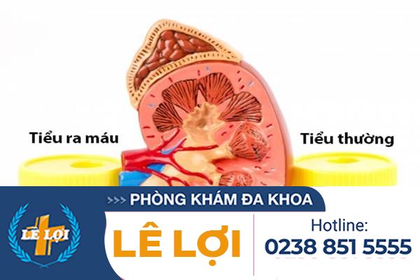 Đi tiểu ra máu là đang mắc bệnh gì?