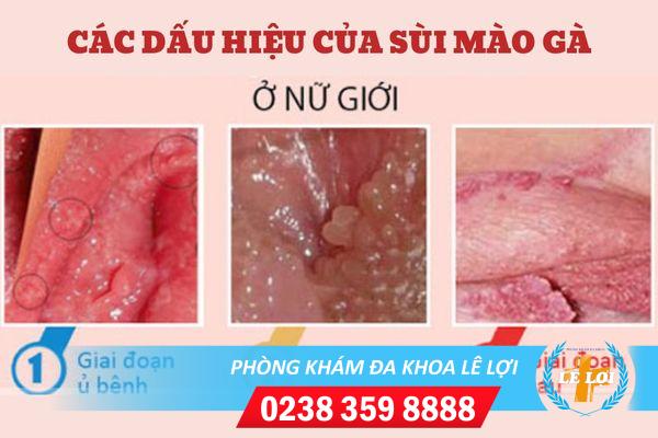 Những thông tin về bệnh sùi mào gà vùng kín nữ