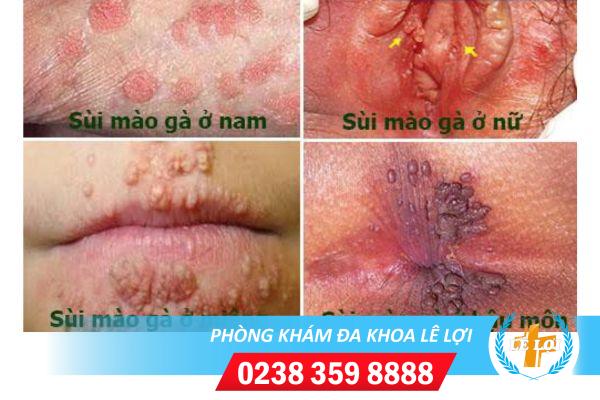 phuong-phap-dieu-tri-sui-mao-ga-an-toan-hieu-qua-1