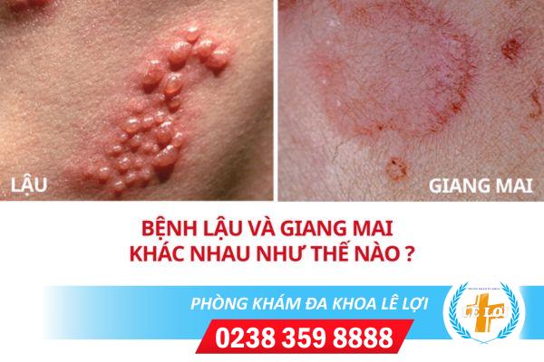 Sự khác biệt giữa bệnh lậu và giang mai