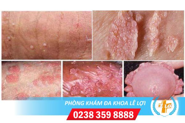 Hình ảnh sùi mào gà vùng kín giúp bạn nhận biết sớm