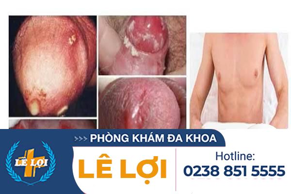 Bệnh lậu ở nam giới: triệu chứng & cách phòng ng