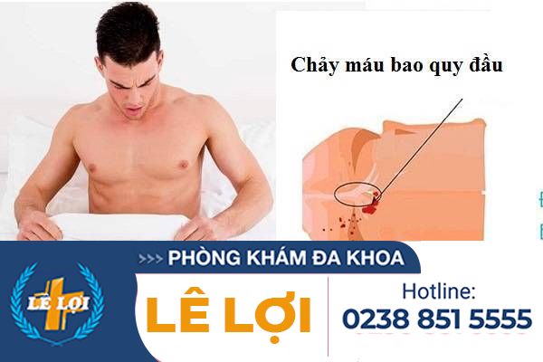 Chảy máu bao quy đầu là bị bệnh gì?