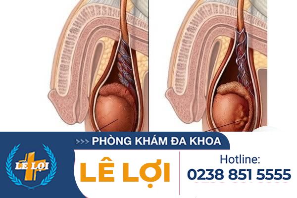 U tinh hoàn – Căn bệnh mà nam giới cần phải đề phòng