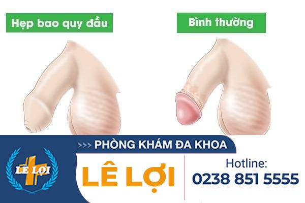 Các dấu hiệu hẹp bao quy đầu ở nam giới không nên chủ quan