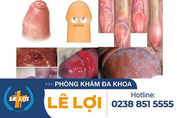 dia-chi-chua-viem-bao-quy-dau