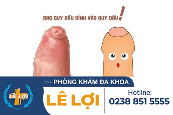 Dính bao quy đầu có nguy hiểm không?
