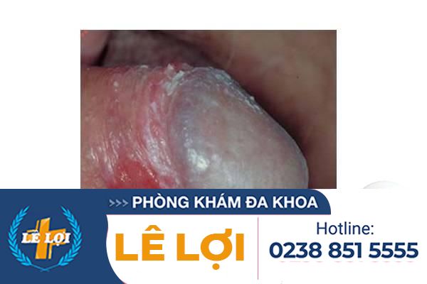 hinh-anh-viem-bao-quy-dau-nam