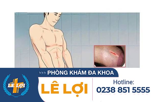 Khi bị rách bao quy đầu cần xử lý thế nào?