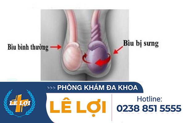 Hiện tượng sưng tinh hoàn và các kiến thức cần biết
