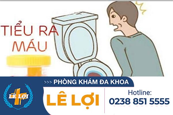 Đái ra máu – Cẩn thận với những bệnh lý nguy hiểm