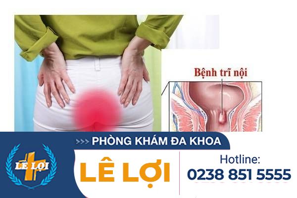 Cách điều trị trĩ nội hiệu quả địa chỉ uy tín