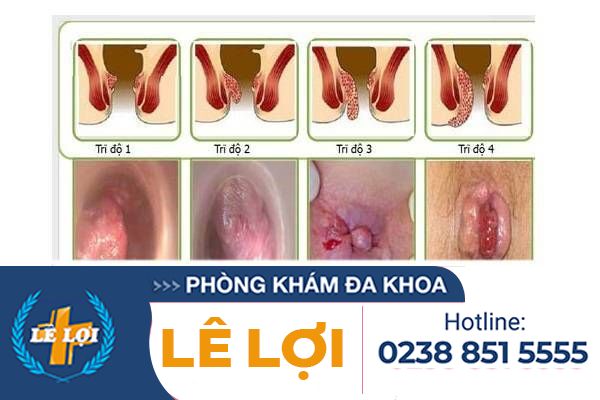 dau-hieu-benh-tri-noi