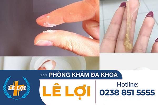 Bệnh huyết trắng là bệnh gì dấu hiệu nhận biết