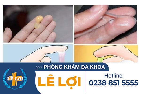 Khí hư có màu và mùi bất thường cảnh báo bệnh gì?