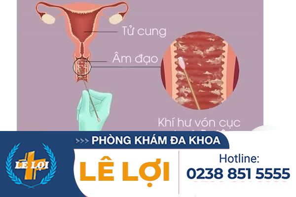 Khí hư vón cục là bị bệnh gì cách điều trị