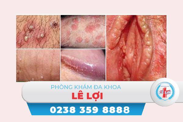 U nhú sinh dục là bị bệnh gì khắc phục thế nào?