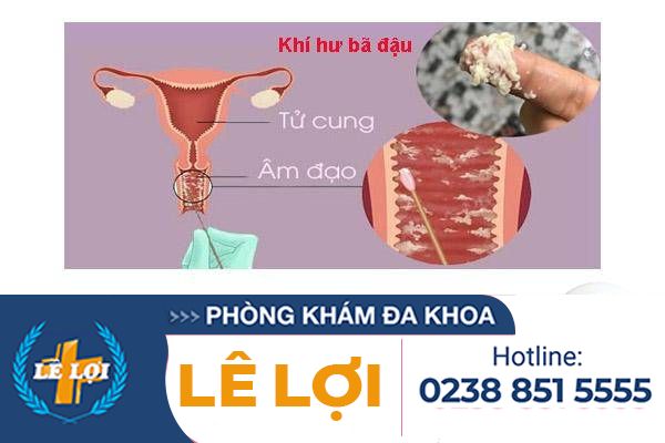 Khí hư bã đậu là bị bệnh gì?