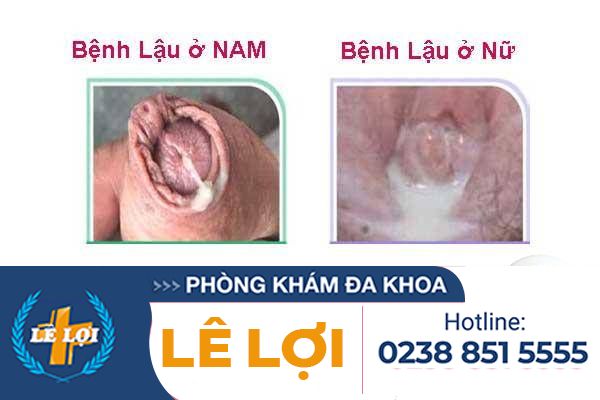 benh-lau-trieu-chung-la-gi