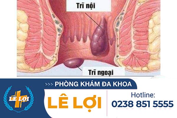 Cách điều trị trĩ cấp tính hiệu quả