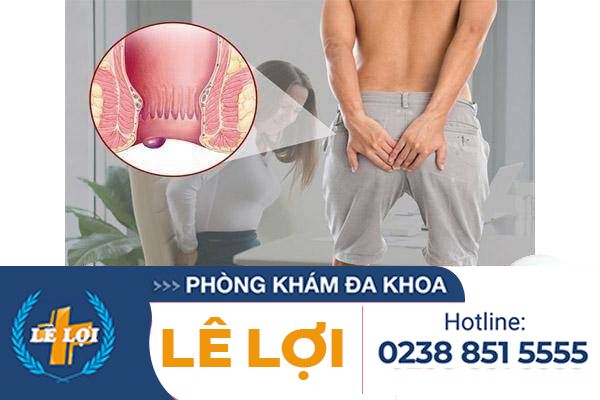 Trĩ ngoại các cấp độ nặng nhẹ