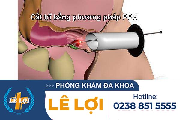 Cắt trĩ bằng phương pháp PPH là gì?