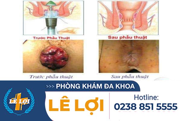 Phương pháp cắt trĩ Longo có tốt không?