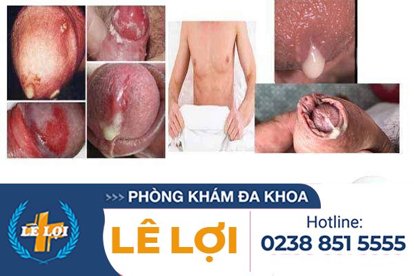 Niệu đạo chảy mủ nguy hiểm không?