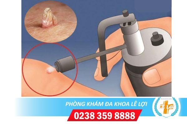 Bệnh viện đốt sùi mào gà uy tín tại Vinh Nghệ An