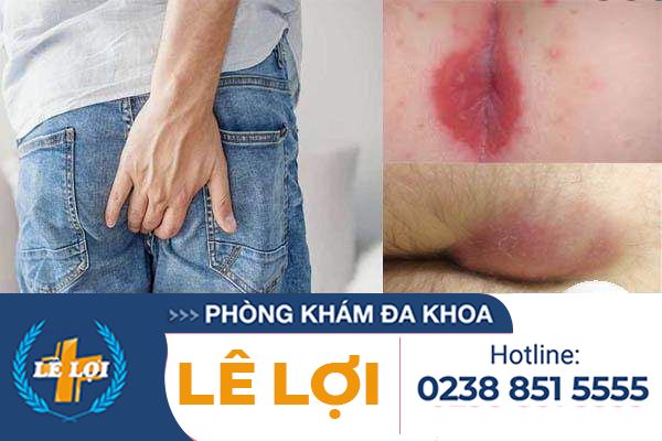 Cách chữa nấm hậu môn hiệu quả
