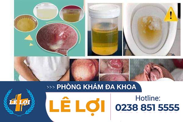 Tiểu có dịch nguy hiểm không?