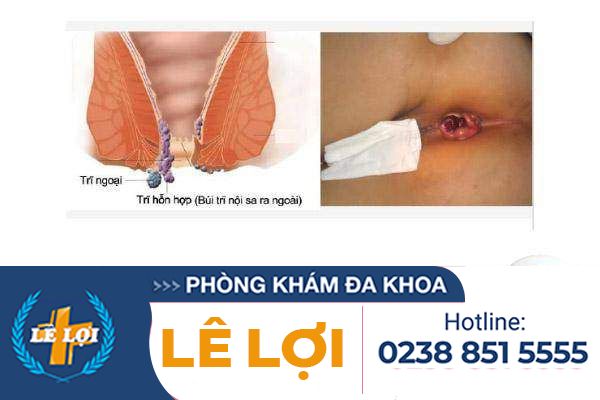 tri-hon-hop-dau-hieu