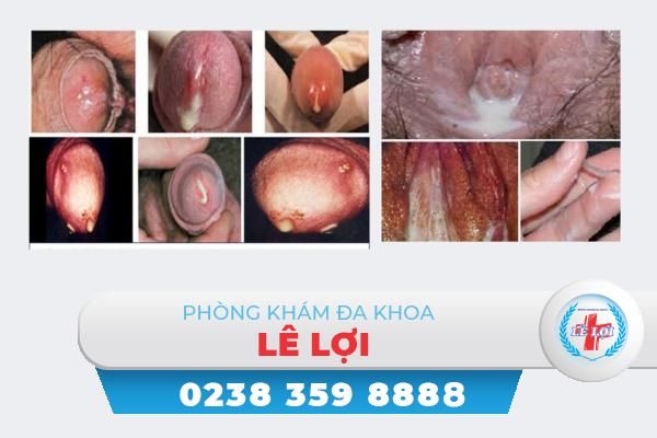 Chảy mủ sinh dục là bệnh gì nguy hiểm không?