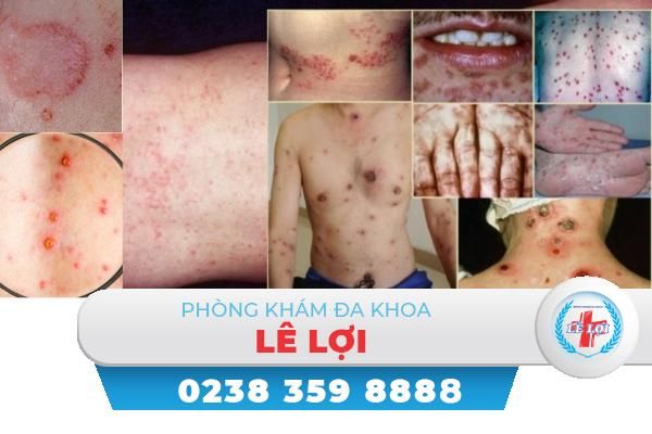 Bệnh phong tình là gì nguy hiểm không?