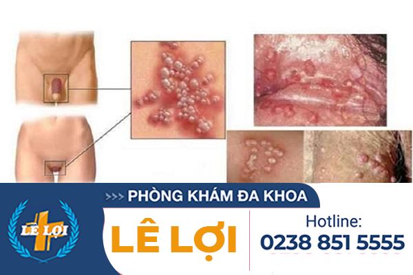 Bệnh herpes sinh dục là bệnh gì?