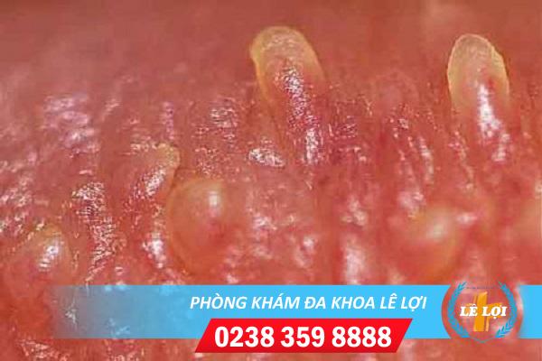 Bệnh gai sinh dục và những điều cần biết