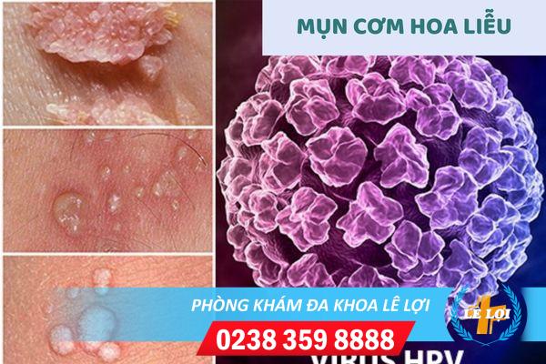Mụn cơm hoa liễu là bệnh gì nguy hiểm không?